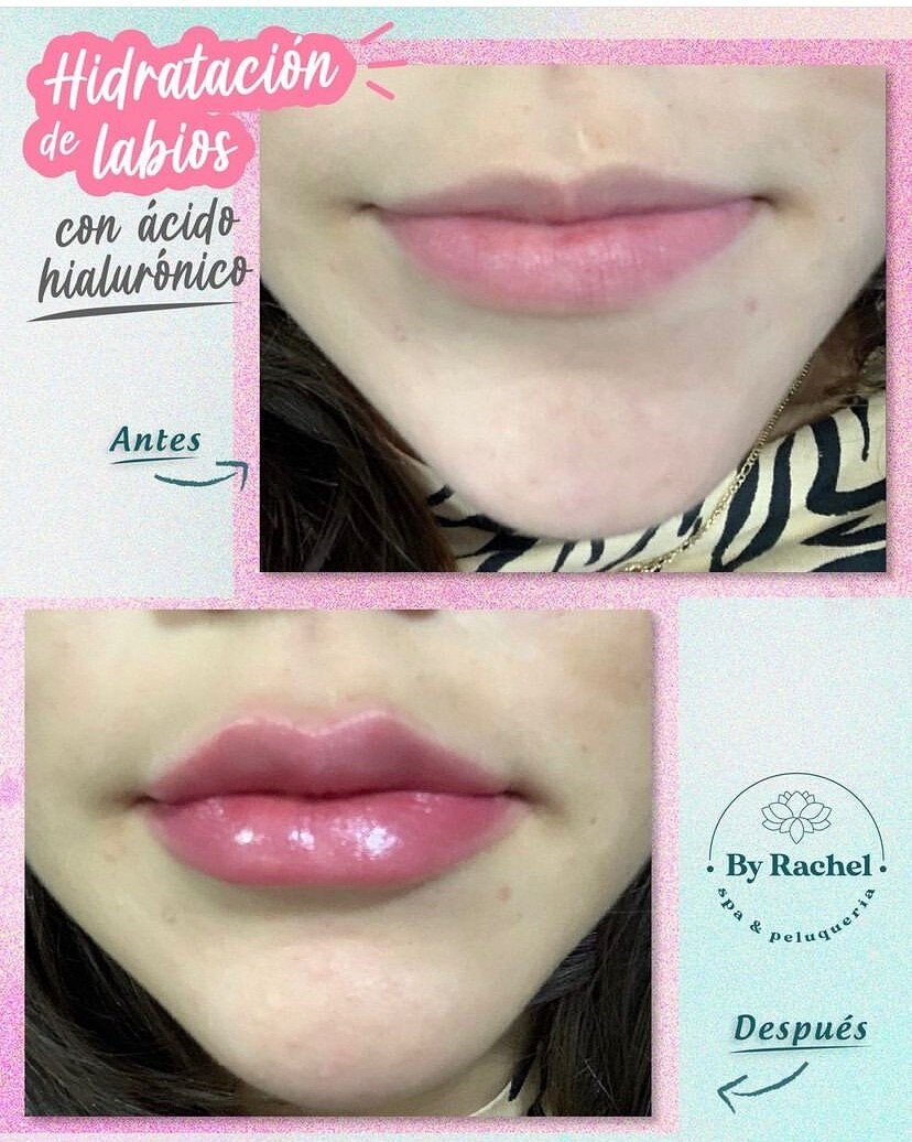 Antes y después de hidratación de labios